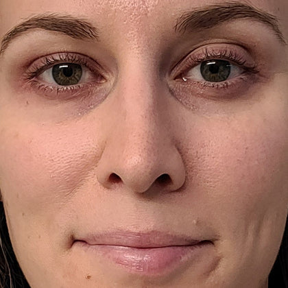 Before - More Even Tone