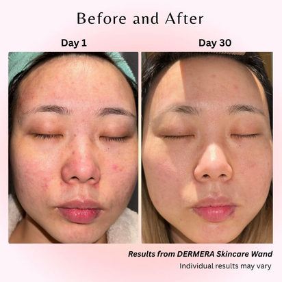 Dermara™ Glow Wand 4-in-1 Red Light Therapy for Radiant Skin