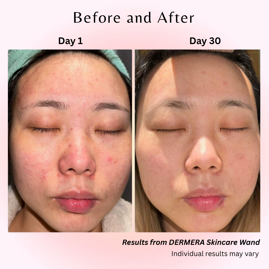 Dermara™ Glow Wand 4-in-1 Red Light Therapy for Radiant Skin