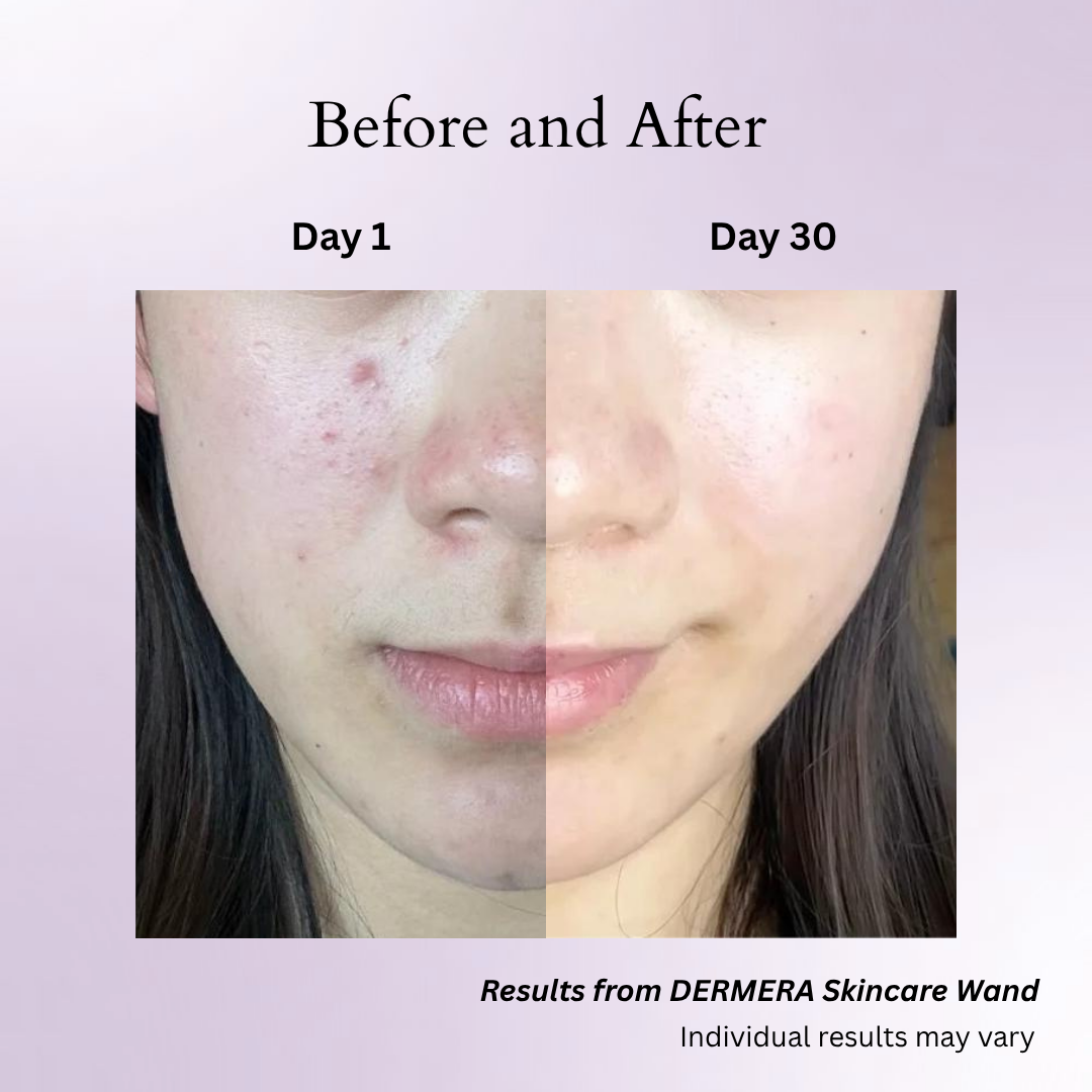 Dermara™ Glow Wand 4-in-1 Red Light Therapy for Radiant Skin