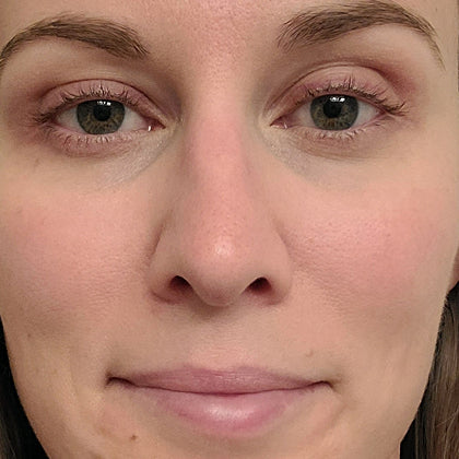 After - More Even Tone