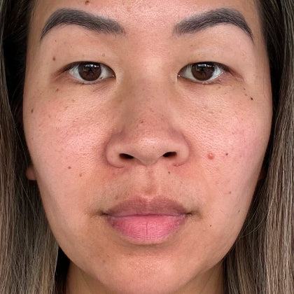 Before - Smoother Skin