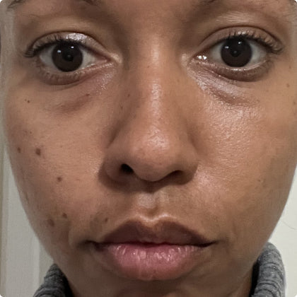 Before - Youthful Glow